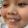 戴牙套的王同学